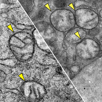 Images of how mitochondria appear in pancreatic tu