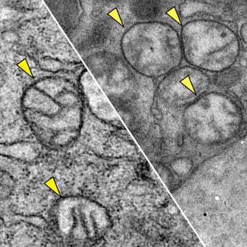 Images of how mitochondria appear in pancreatic tu